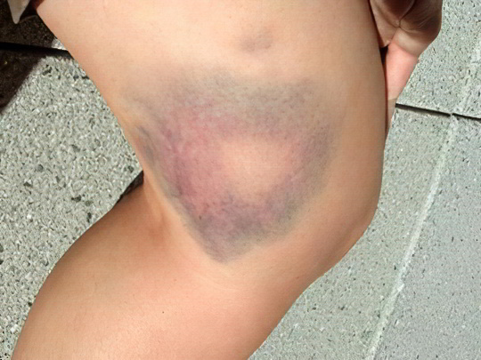 Гематома Гематома