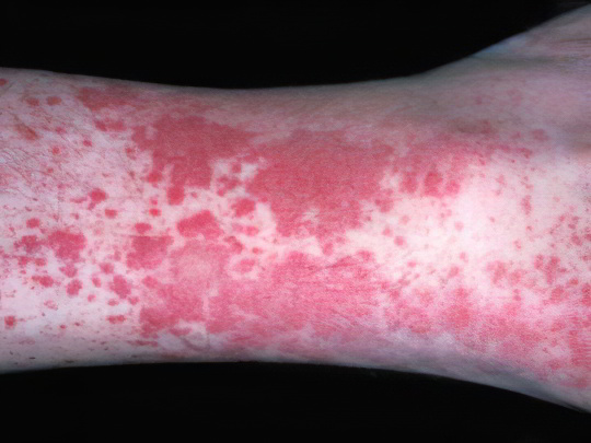 Геморрагический васкулит Геморрагический васкулит