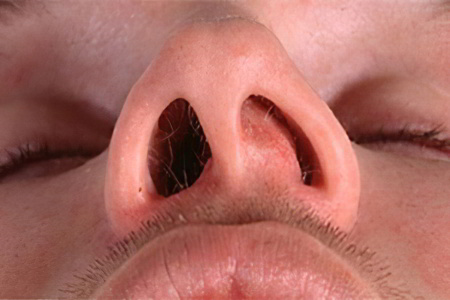 Герпес Герпес