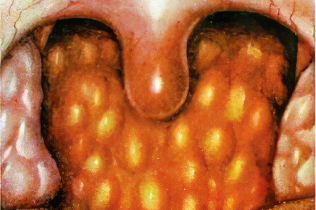 Герпетический фарингит Герпетический фарингит