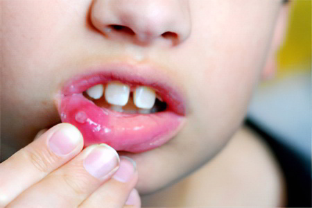 Герпетический стоматит у детей Герпетический стоматит у детей
