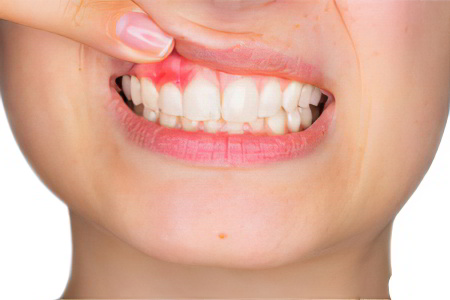 Гингивит Гингивит