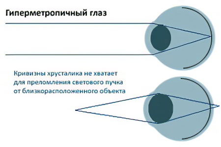 Гиперметропия Гиперметропия