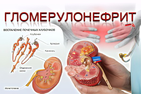 гломерулонефрит гломерулонефрит