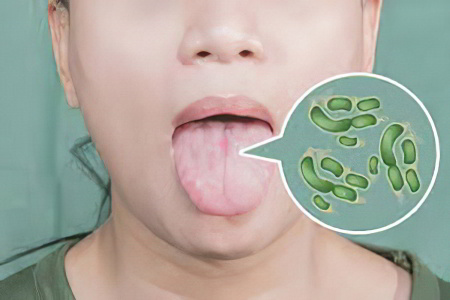 глоссит глоссит