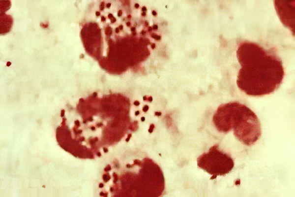 Гнойный простатит Гнойный простатит