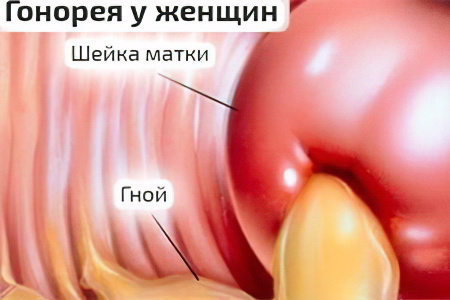 Гонорея у женщин Гонорея у женщин