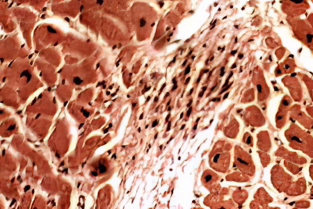 гранулёма гранулёма