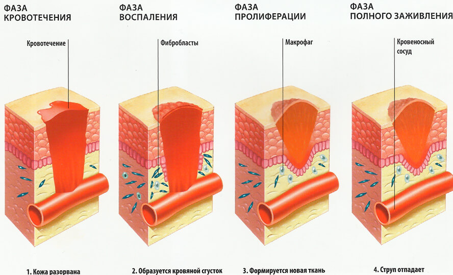 Грануляционное восстановление тканей Грануляционное восстановление тканей