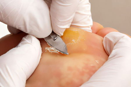 Хирургическое удаление мозоли Хирургическое удаление мозоли