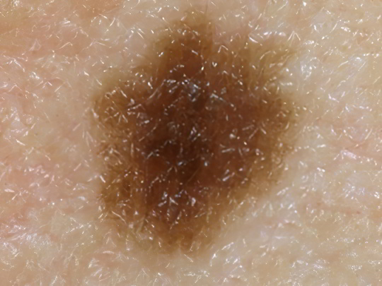 Хлоазмы Хлоазмы