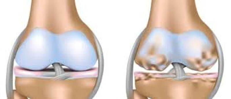 Остеохондропатии Остеохондропатии