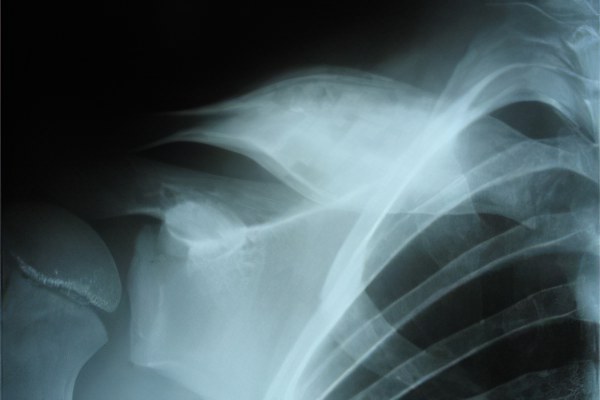 Хронический остеомиелит Хронический остеомиелит