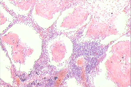 Хронический абсцесс лёгкого Хронический абсцесс лёгкого