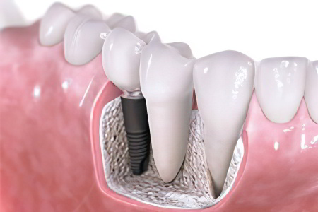 Имплантация зубов Имплантация зубов
