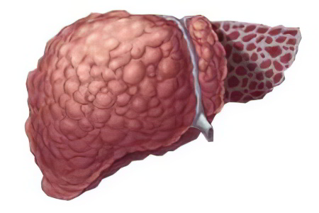 Осложнения инфекционного гепатита Осложнения инфекционного гепатита