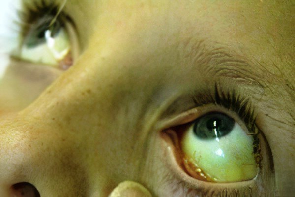 Инкубационный период Инкубационный период