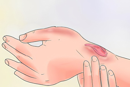 Как лечить мокнущую рану Как лечить мокнущую рану