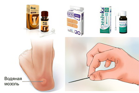 Как правильно проколоть мозоль Как правильно проколоть мозоль