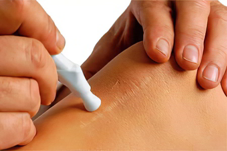 Как восстановить кожу после ожога Как восстановить кожу после ожога