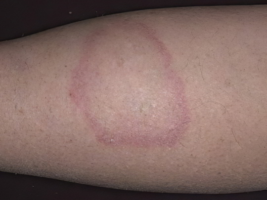 Кольцевидная гранулёма Кольцевидная гранулёма