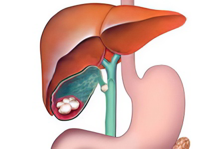 калькулезный холецистит калькулезный холецистит