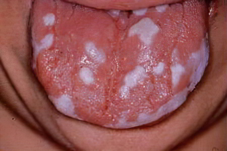 Кандидозный стоматит Кандидозный стоматит