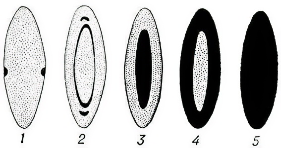 Стадии возрастной катаракты Стадии возрастной катаракты
