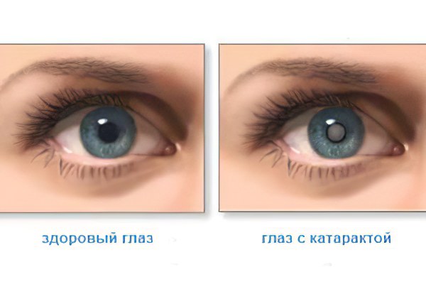 катаракта катаракта