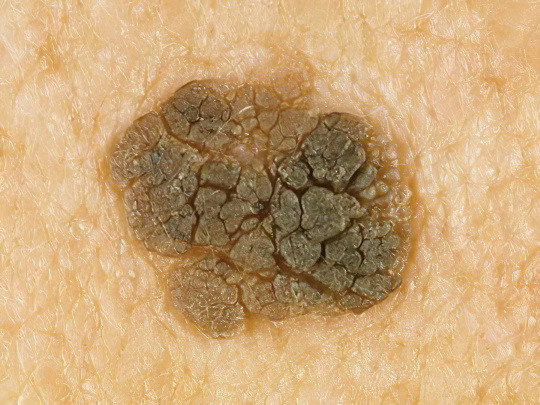 Кератома Кератома