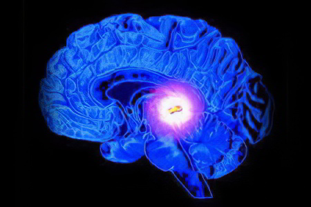 Киста головного мозга Киста головного мозга