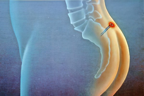 Киста копчика Киста копчика