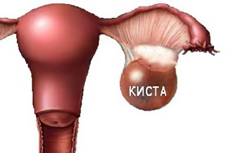Киста яичника Киста яичника