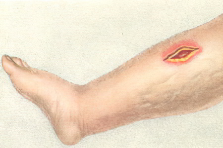 Клинические формы газовой гангрены Клинические формы газовой гангрены