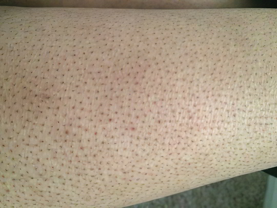 Вросшие волоски Вросшие волоски