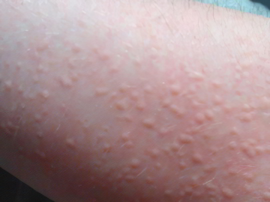 Крапивница Крапивница