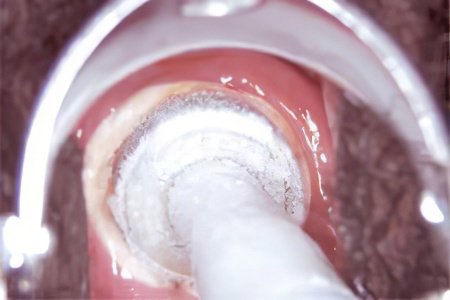 Криодеструкция Криодеструкция