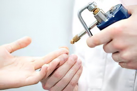 Криодеструкция Криодеструкция