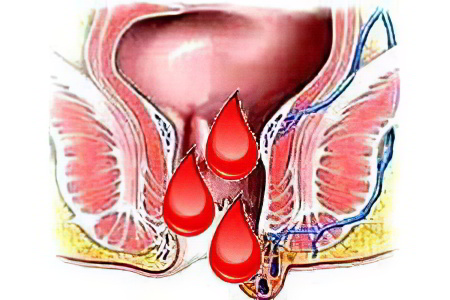 Кровотечение из заднего прохода Кровотечение из заднего прохода