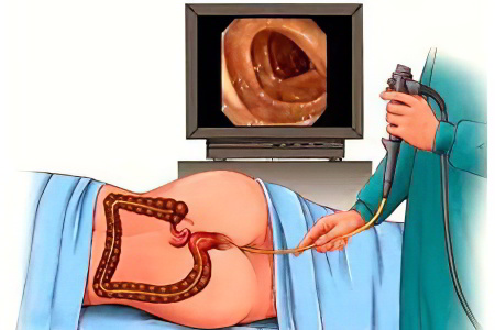 Кровотечение из заднего прохода Кровотечение из заднего прохода