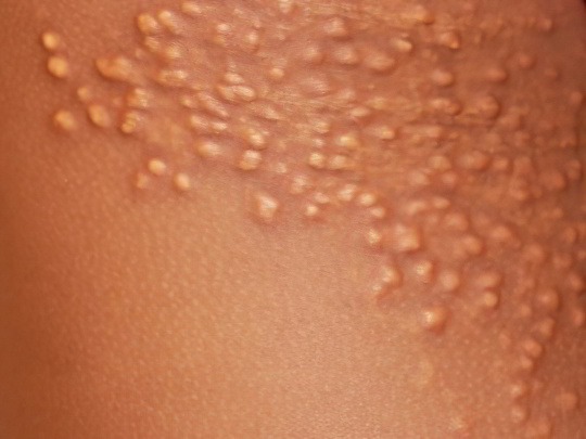 Ксантоматоз Ксантоматоз