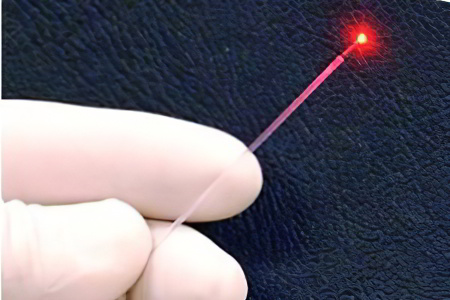 Лазеровапоризация Лазеровапоризация