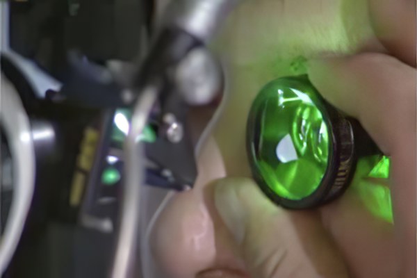 лазерная коагуляция лазерная коагуляция