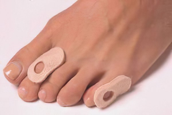 Лечение натоптышей Лечение натоптышей