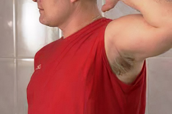 Лечение потницы у взрослых Лечение потницы у взрослых