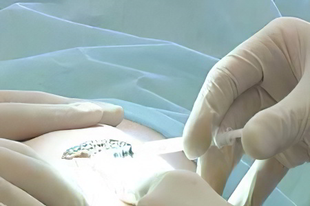 Лечение веррукозного невуса Лечение веррукозного невуса