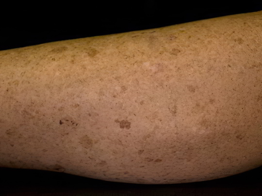 Лентиго Лентиго