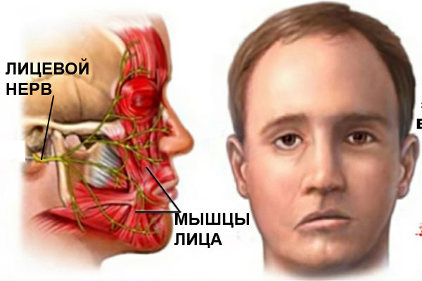 лицевого нерва лицевого нерва