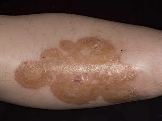 Липоидный некробиоз Липоидный некробиоз