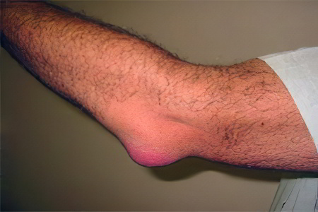 локтевой бурсит локтевой бурсит